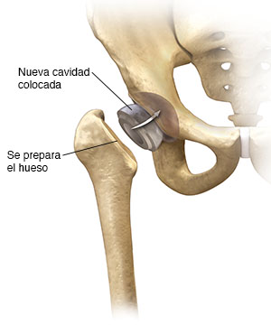 Vista frontal de la cadera donde puede verse parte del reemplazo de cadera que se está colocando.