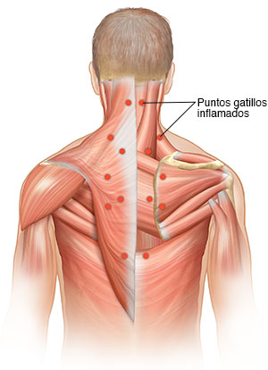 Torso de hombre donde pueden verse músculos superficiales de la espalda. Se muestran los puntos gatillo inflamados.
