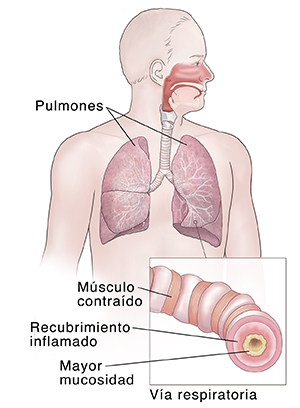 Vista frontal de un hombre en donde se ve el sistema respiratorio. Recuadro que muestra una vía respiratoria inflamada.