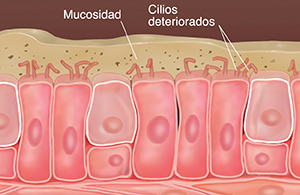 Células con cilios dañados que muestran acumulación de mucosidad y partículas en la mucosidad.