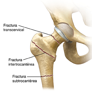 Vista frontal de la articulación de la cadera con tres tipos de fracturas de cadera.