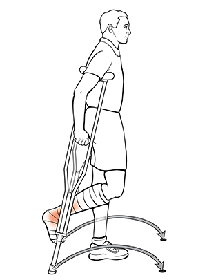 Vista lateral de un hombre usando muletas. La flecha indica dónde colocar las muletas después de mover el pie para la técnica pendular.