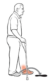 Vista lateral de un hombre con un bastón. La flecha muestra dónde debería poner el otro pie.