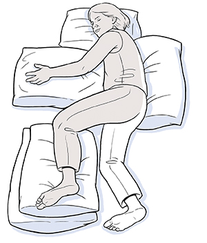 Mujer acostada sobre el lado no afectado por un accidente cerebrovascular, con la espalda, la cabeza, el brazo y la pierna no afectados apoyados sobre almohadas.
