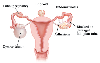 Aparato reproductor femenino que muestra ejemplos de problemas de fecundidad como embarazo tubárico, fibroma, endometriosis, adherencias, trompa de Falopio obstruida y quiste o tumor.