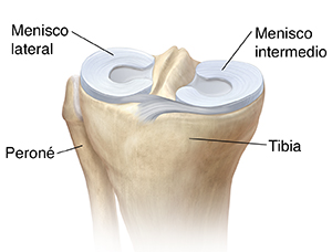 Vista tres cuartos de la parte superior de la tibia donde se observan el menisco lateral y el menisco medial.