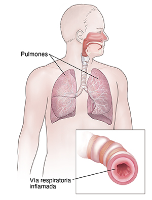 Vista frontal del cuerpo de un hombre en donde se observa el aparato respiratorio. El recuadro muestra una vía respiratoria inflamada.