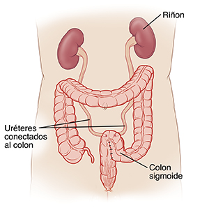 Vista delantera de un torso, donde pueden verse los riñones conectados al colon sigmoide por medio de los uréteres.