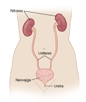 Vista frontal del bosquejo de una mujer, donde pueden verse los riñones, los uréteres y la neovejiga.