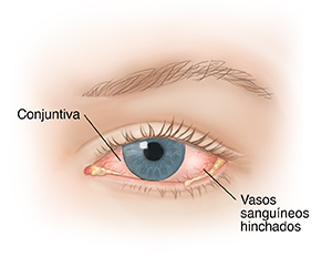 Vista frontal de un ojo donde se observa conjuntivitis.