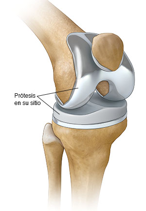 Articulación de una rodilla doblada que muestra una prótesis colocada.