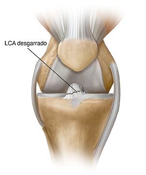 Vista frontal de articulación de la rodilla que muestra músculos, huesos y ligamentos con un desgarro parcial del ligamento cruzado anterior.