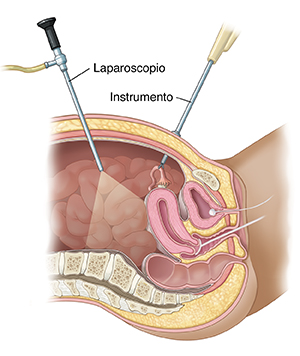Corte transversal de pelvis de mujer vista de lado donde puede verse una laparoscopia.
