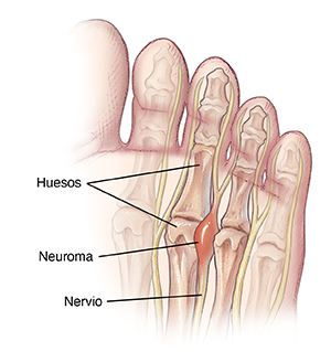 Planta de un pie que muestra los huesos, los nervios y un neuroma entre dos huesos.