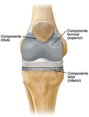 Vista frontal de una prótesis de rodilla.