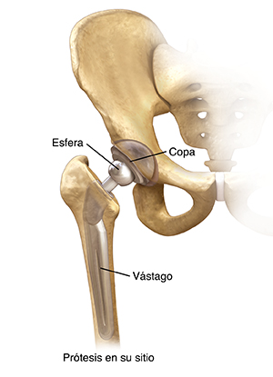 Vista frontal de la articulación de la cadera que muestra una prótesis colocada.
