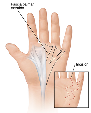 Vista de la palma de la mano, donde puede verse la fascia palmar extirpada con un recuadro que muestra una incisión en forma de zigzag.