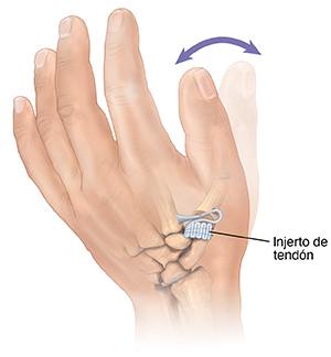 Vista posterior de una mano que muestra un injerto de ligamento que reemplaza la articulación en la base del pulgar.