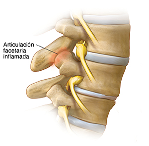 Vista lateral de tres vértebras donde se observa una articulación facetaria inflamada.