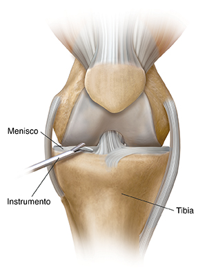 Vista frontal de rodilla en donde se ve un instrumento que quita un trozo de menisco.