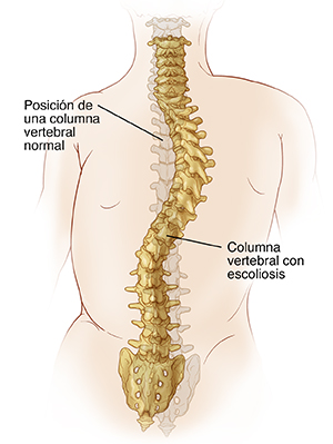 Vista posterior de la columna vertebral con escoliosis y la posición normal de la columna vertebral en imagen fantasma.