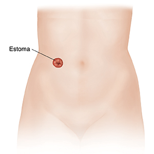 Vista frontal de un torso y pelvis de mujer donde puede verse un estoma urinario después de una cistectomía.