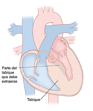 Vista de las cuatro cámaras del corazón con el tabique y el ventrículo izquierdo engrosados. El área sombreada indica la parte del tabique que debe extraerse en la miectomía septal.