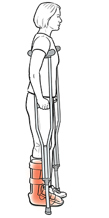 Vista lateral de una mujer parada con muletas y usando un zapato ortopédico en un pie.