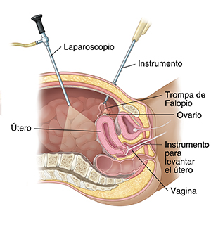 Corte transversal de una pelvis de mujer vista de lado donde se ve la laparoscopia.