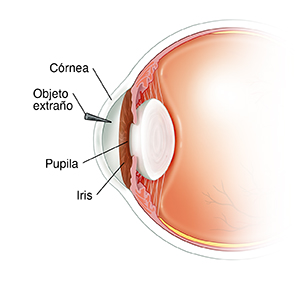 Corte transversal lateral de la parte delantera del ojo que muestra la pupila, el iris y un cuerpo extraño alojado en la córnea.