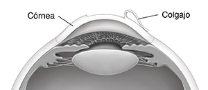 Corte transversal de un ojo que muestra un colgajo en la córnea.