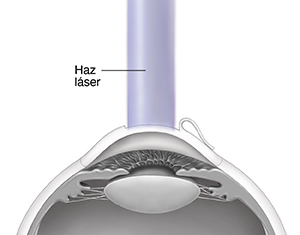 Corte transversal de un ojo que muestra cómo el rayo láser remodela la córnea debajo del colgajo.