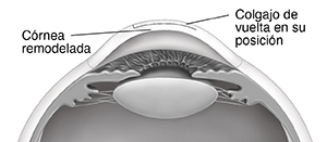 Corte transversal de un ojo que muestra la córnea remodelada y el colgajo sustituido.