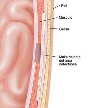 Corte transversal de una pared abdominal donde puede verse la reparación de una hernia utilizando una malla.