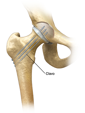 Vista frontal de la articulación de la cadera que muestra pernos que reparan una fractura femoral.