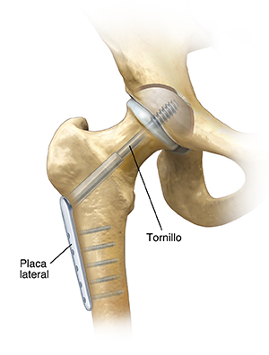 Vista frontal de la articulación de la cadera que un tornillo de compresión que repara una fractura femoral.