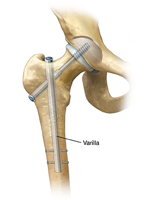 Vista frontal de la articulación de la cadera que muestra una varilla que repara una fractura femoral.