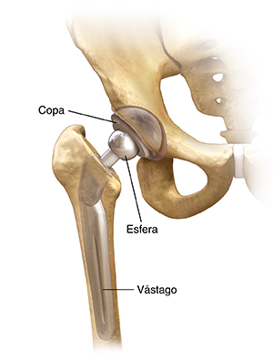 Vista frontal de la articulación de la cadera que muestra una prótesis colocada.