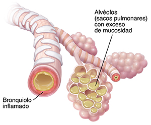 Bronquiolos y alvéolos con acumulación de mucosidad e inflamación debido a la neumonía.
