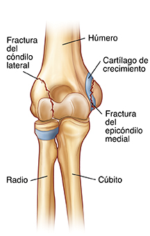Vista frontal de una articulación de codo en donde se muestran una fractura lateral condílea y una fractura del epicóndilo medial.