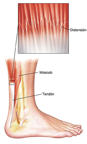 Vista lateral de la parte inferior de la pierna que muestra los huesos, músculos y tendones del talón y la pierna. Primer plano que muestra un esguince en el músculo cerca del tendón.