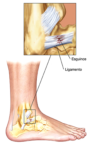 Vista lateral de la parte inferior de la pierna que muestra los huesos, músculos y tendones del talón y la pierna. Primer plano que muestra un esguince (daño) en el ligamento.Vista lateral de la parte inferior de la pierna que muestra los huesos, músculos y tendones del talón y la pierna. Primer plano que muestra un esguince en el ligamento.