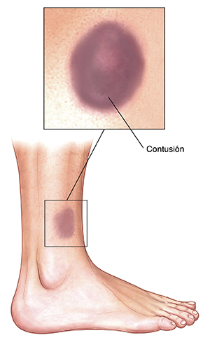 Vista lateral de la parte inferior de la pierna que muestra una contusión en la piel.