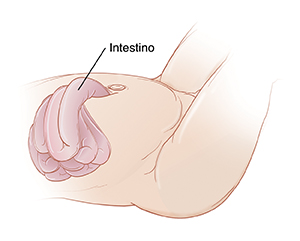 Primer plano de abdomen de bebé donde puede verse el intestino que sale a través de un defecto en el abdomen.