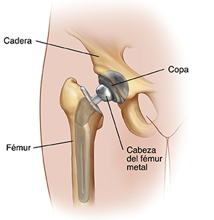 Vista frontal de la articulación de la cadera que muestra el reemplazo total de cadera.