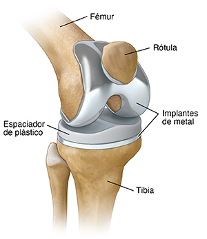 Vista de tres cuartos de la rodilla con prótesis total de rodilla colocada.