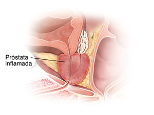 Corte transversal de una glándula prostática donde puede verse inflamación.