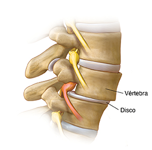 Vista lateral de la columna lumbar donde puede verse una vértebra que se desliza hacia adelante y presiona el nervio.