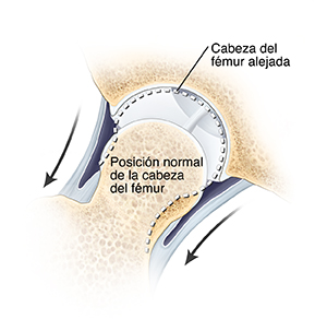 Corte transversal de una articulación de cadera con flechas que muestran cómo se separa la cabeza del fémur de la cavidad de la cadera. Una línea de puntos muestra la posición normal de la cabeza del fémur en la cavidad.