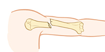 Parte superior del brazo donde se observa una fractura con desplazamiento.